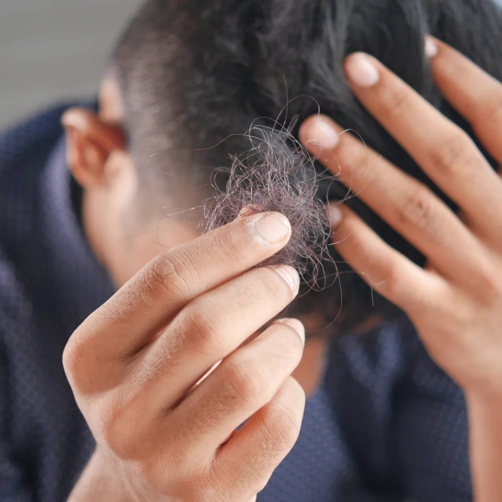 Mann mit Haarbüschel in Hand sucht Alternative zur Haartransplantation