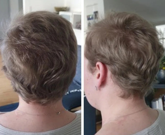 Erfahrungen bei Haarausfall durch Chemotherapie