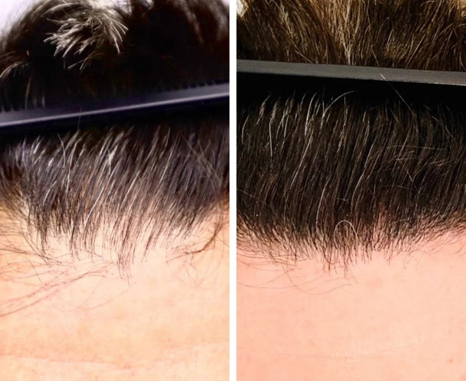 Erfahrungen bei Haarausfall trotz Haartransplantation