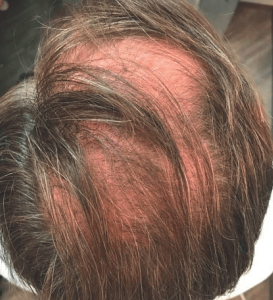 Haarausfall Mann vor Behandlung