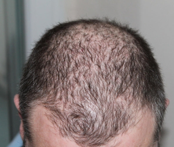 Mann mit wenig Haaren will Haarausfall stoppen