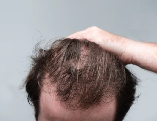 Perte de cheveux chez les hommes