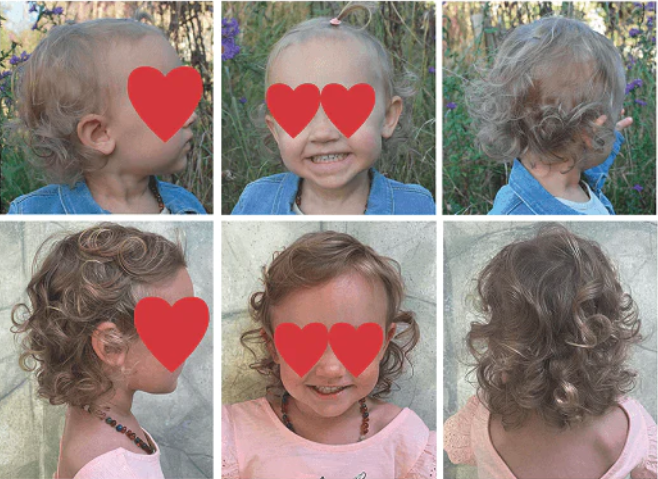 Erfahrungsbild bei Kindern mit Haarausfall